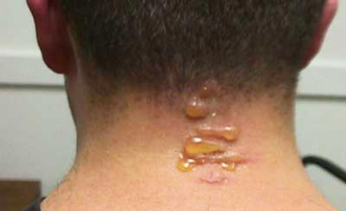 Blisters resulting by smashing a single blister beetle on the neck. While uncomfortable, no medical treatment was implemented and the blisters soon diminished on their own. 